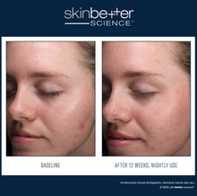 Load image into Gallery viewer, Skinbetter AlphaRet Clearing Serum 30ml