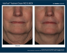 Load image into Gallery viewer, Skinbetter Science InterFuse® Treatment Face and Neck Cream 30ml-Please call 604-773-1191 to place your order.
