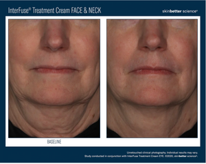 Skinbetter Science InterFuse® Treatment Face and Neck Cream 30ml-Please call 604-773-1191 to place your order.