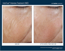 Load image into Gallery viewer, Skinbetter Science InterFuse® Intensive Lines Treatment 15ML-
